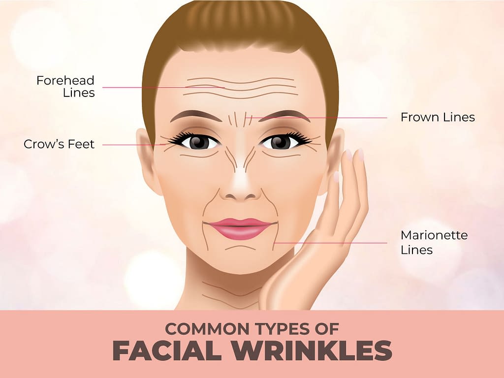 Fine Lines & Wrinkles - Cheongdam Aesthetics Clinic